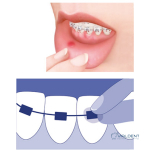 Ортодонтический воск Foramen ORTHODONTIC WAX — изображение 3
