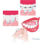 Зубной нитевдеватель Foramen DENTAL THREADERS — изображение 3